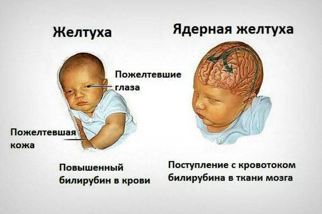 Стоит ли переживать, если у новорожденного физиологическая желтуха?