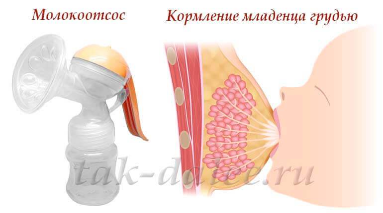 Симптомы и лечение лактостаза у кормящей матери в домашних условиях