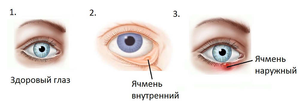 Симптомы и причины ячменя у грудничка, чем и как лечить ребенка