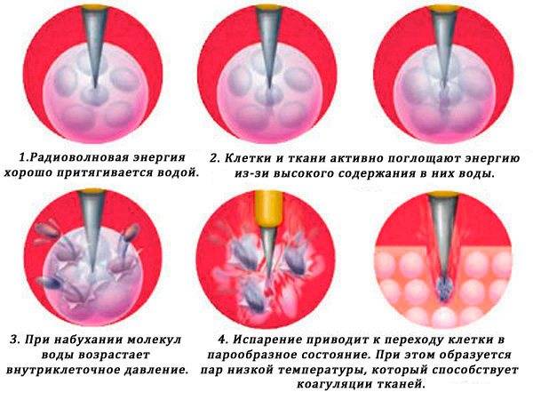 Эрозия шейки матки после родов: как она выглядит, причины ее появления, признаки заболевания, симптомы и лечение + отзывы женщин