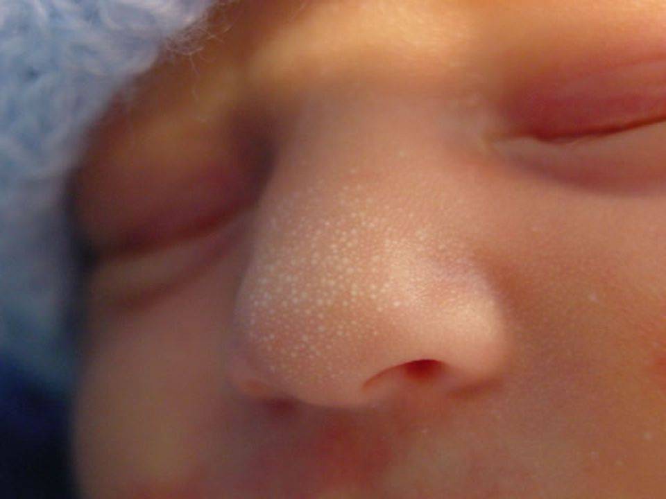 Прыщики на лице новорожденного: из-за чего появляются и что с ними делать