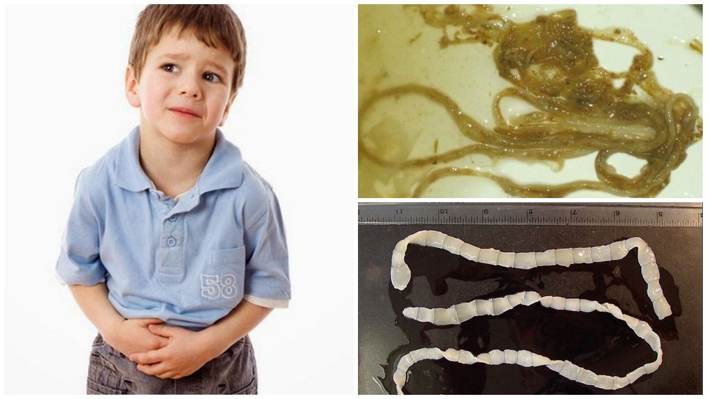 Глисты у детей: как обнаружить и вывести паразитов