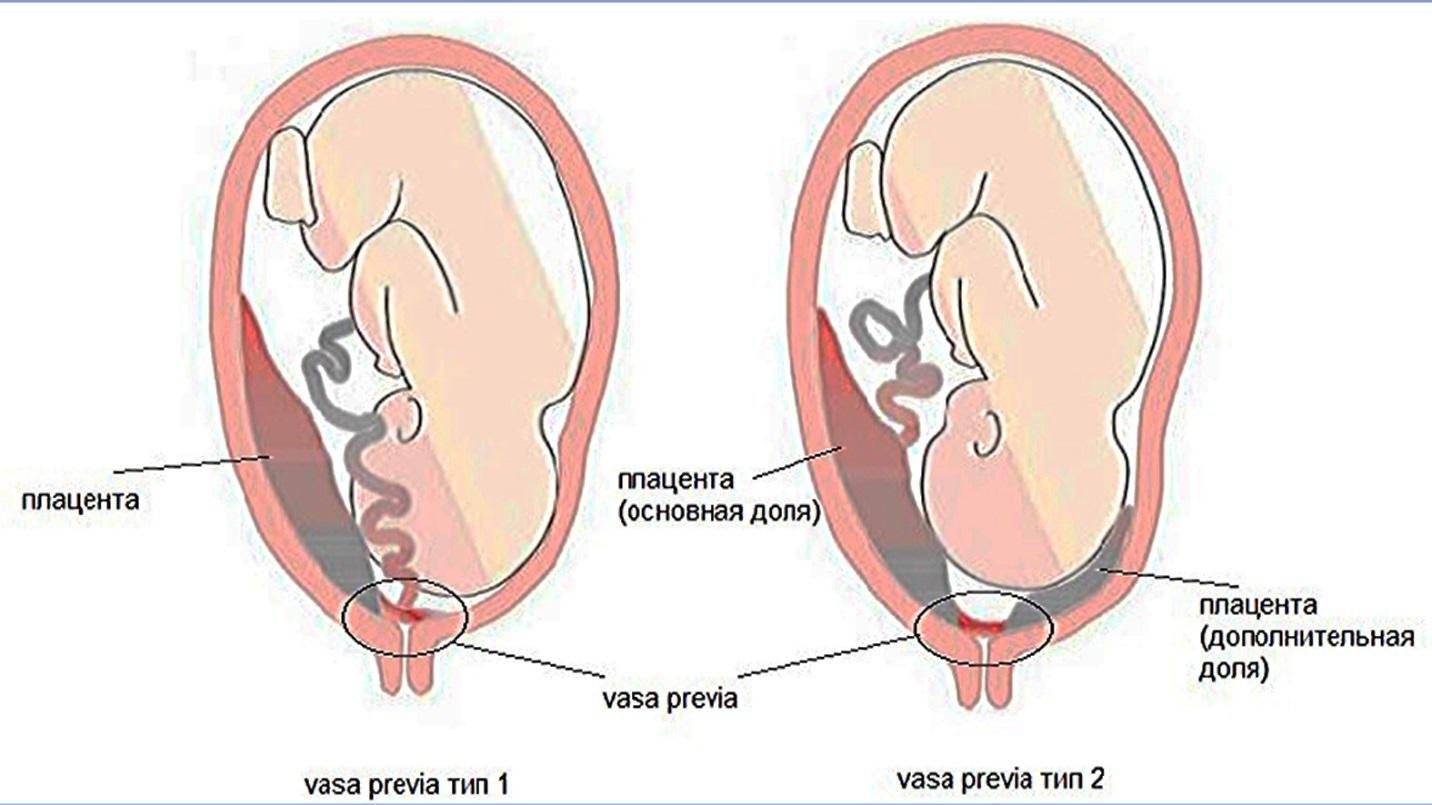 Низкая плацента на 20 неделе беременности