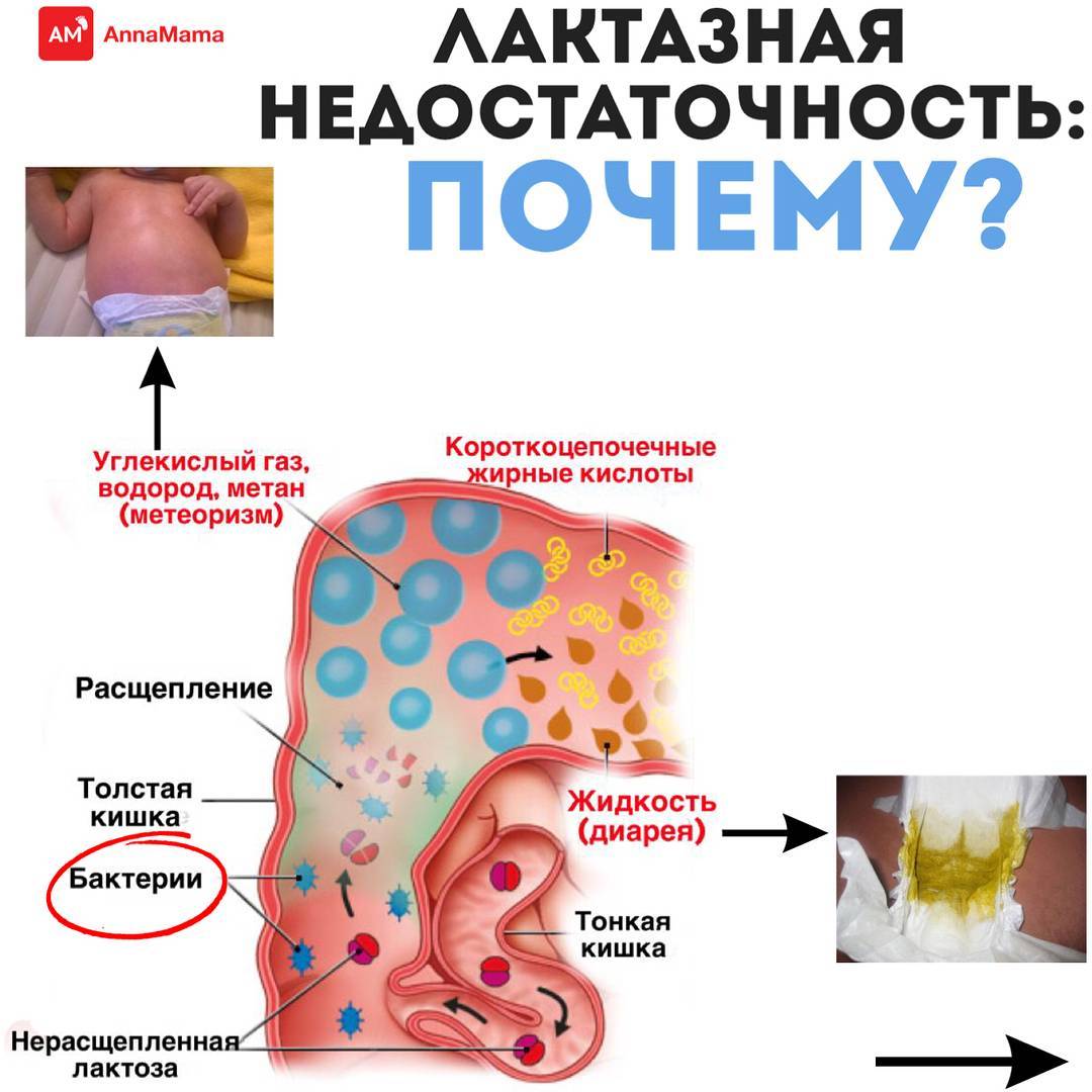 Непереносимость лактозы у грудных детей, симптомы лактозной непереносимости у грудничков