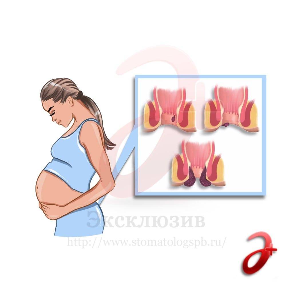 Наружный геморрой при беременности 3