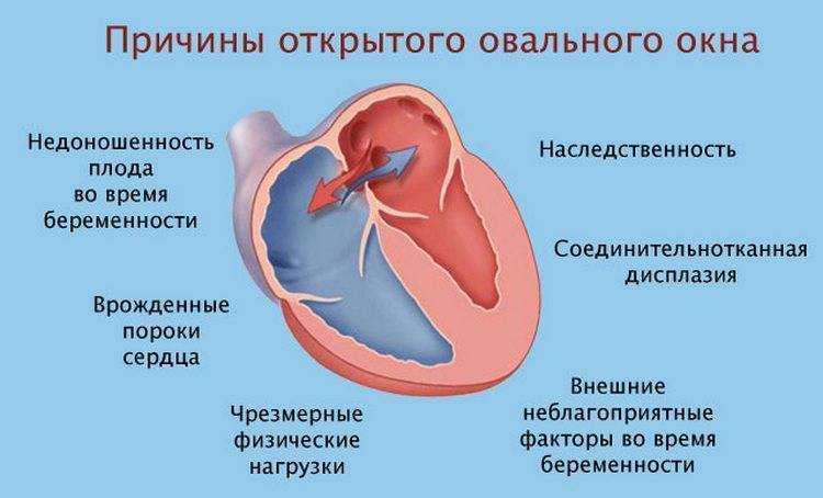 Открытое овальное окно: как проявляется, когда и чем опасно