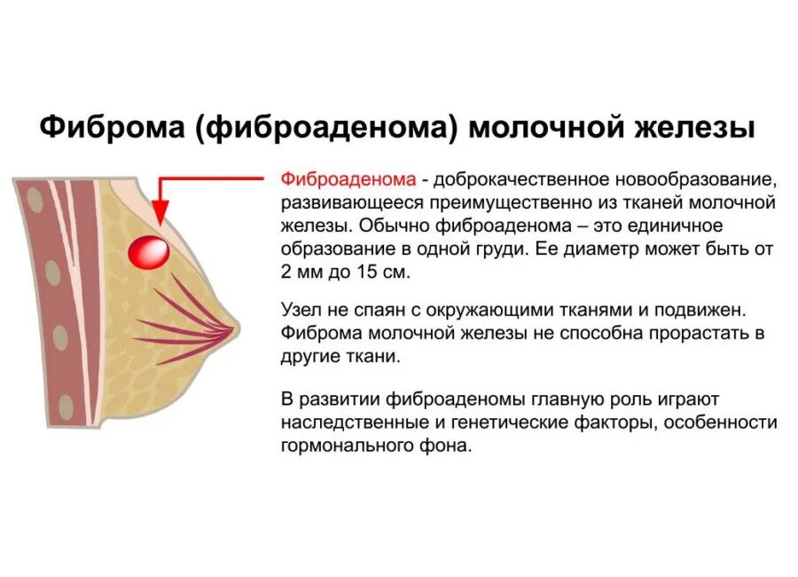 Мастопатия