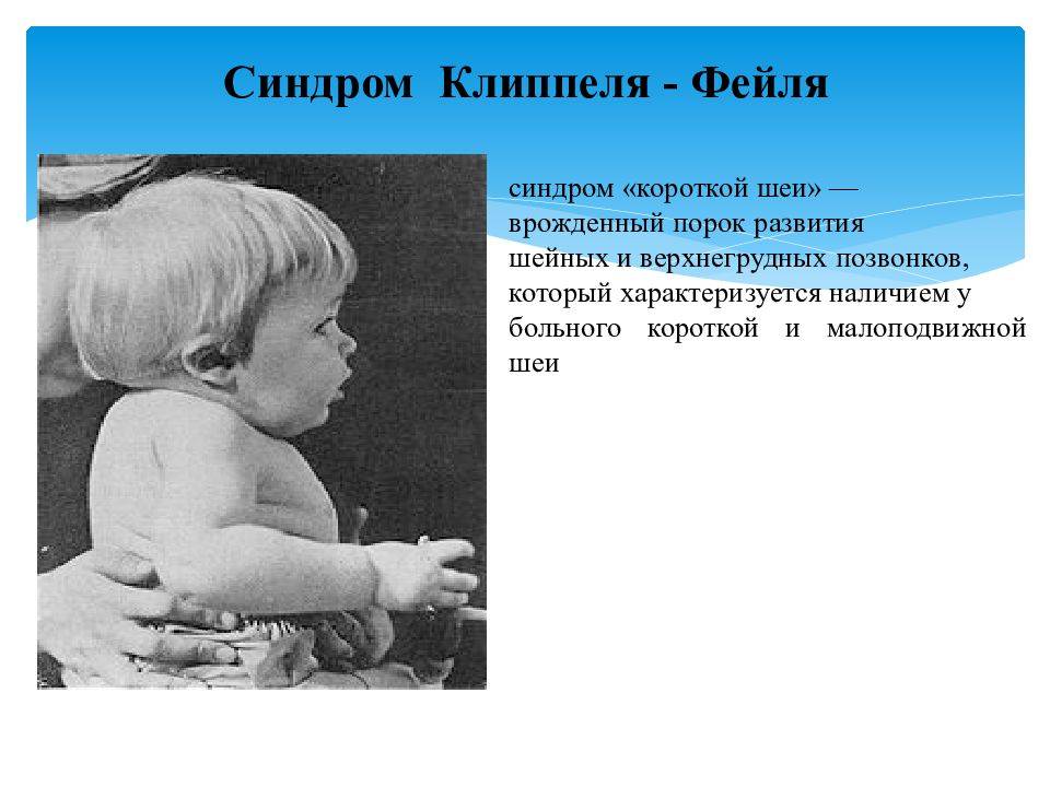 Синдром короткой шеи у новорожденного: причины, симптомы, лечение