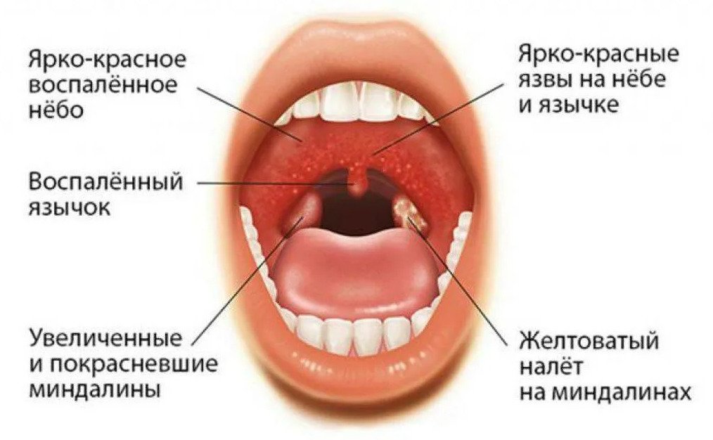 Как лечить герпесную ангину у детей, и чем опасно данное заболевание