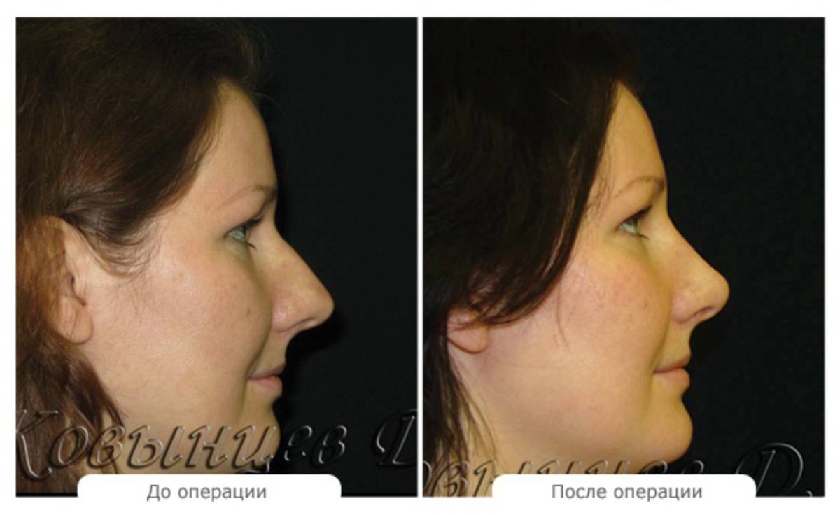 Рост носа в год. Увеличение носа ринопластика. Гормональное увеличение носа. Нос беременных меняется.