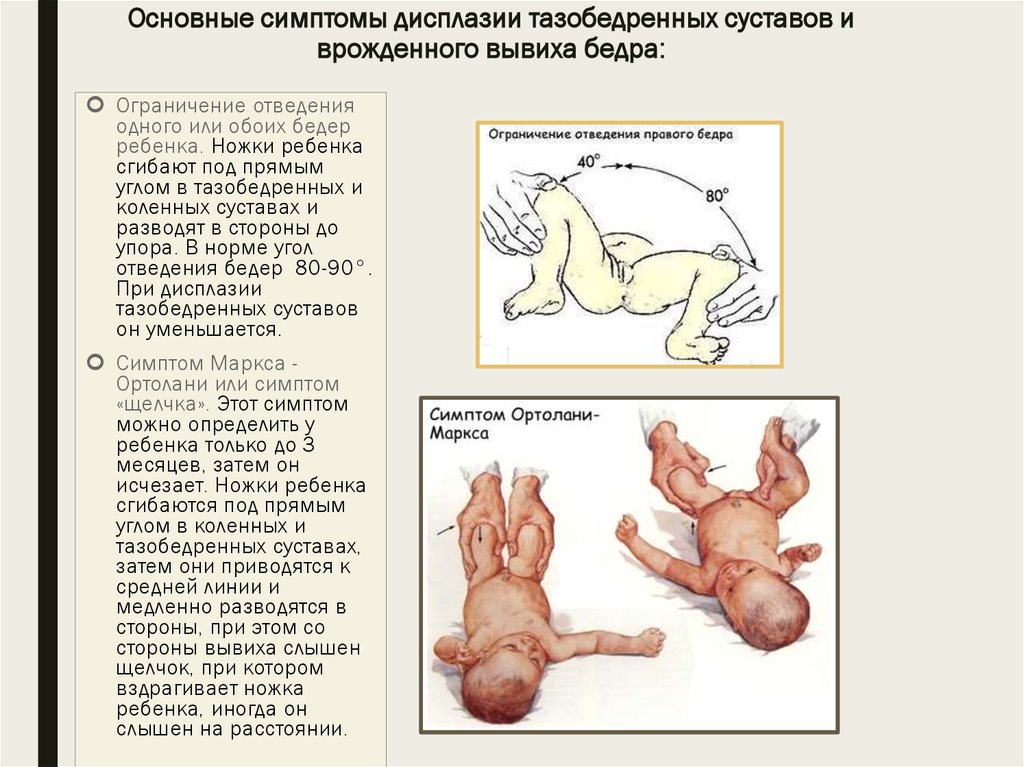 Дисплазия тазобедренного сустава у новорожденных. согласно статистическим данным, в украине дисплазия тазобедренного сустава диагностируется у 5-20% новорожденных детей