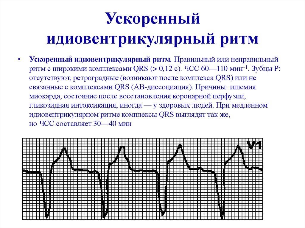 Разновидности тахикардии у детей и четырехступенчатый алгоритм оказания первой помощи ребенку