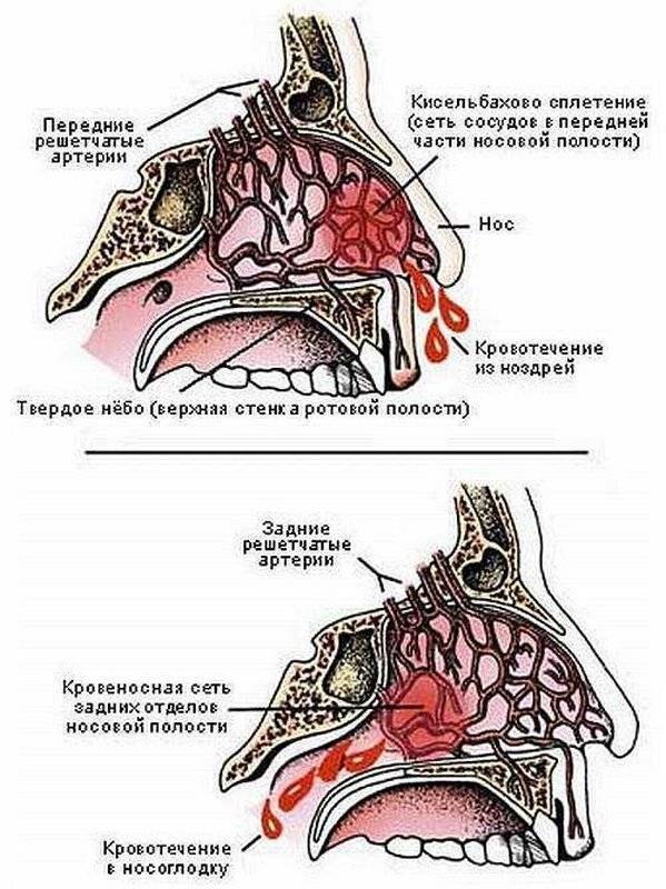 Острое носовое кровотечение. Переднее и заднее носовое кровотечение. Передние и задние носовые кровотечения.