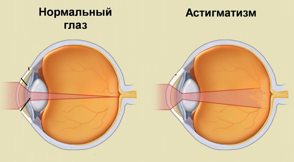Врачебное мнение о том, нужно ли лечить астигматизм у ребёнка
