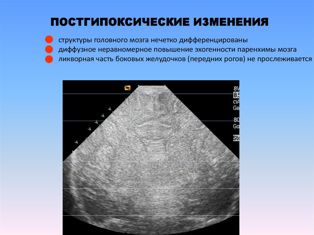 Гипоксия узи. Постгипоксические изменения у новорожденных что это. Постгипоксические изменения головного мозга у новорожденных. Постгипоксические изменения головного мозга у новорожденных УЗИ. Постгипоксические изменения структуры головного мозга у младенца.