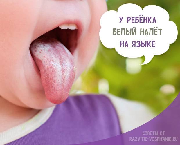 Молочница во рту у грудничка и новорожденного: причины и лечение, профилактика, мнение комаровского