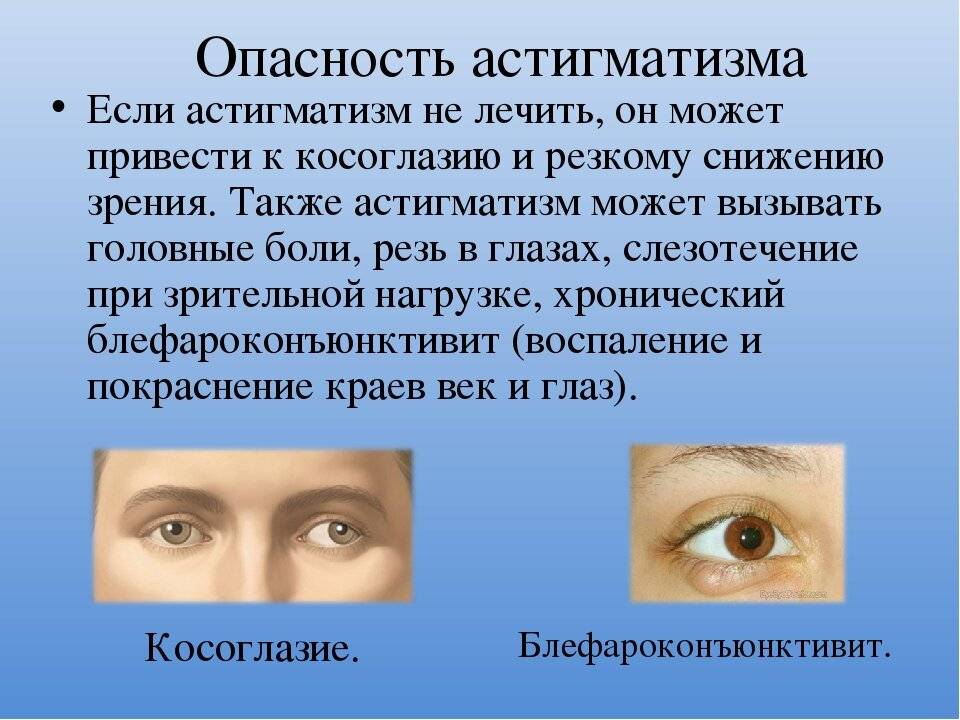 Астигматизм у детей  - причины, признаки, диагностика и лечение