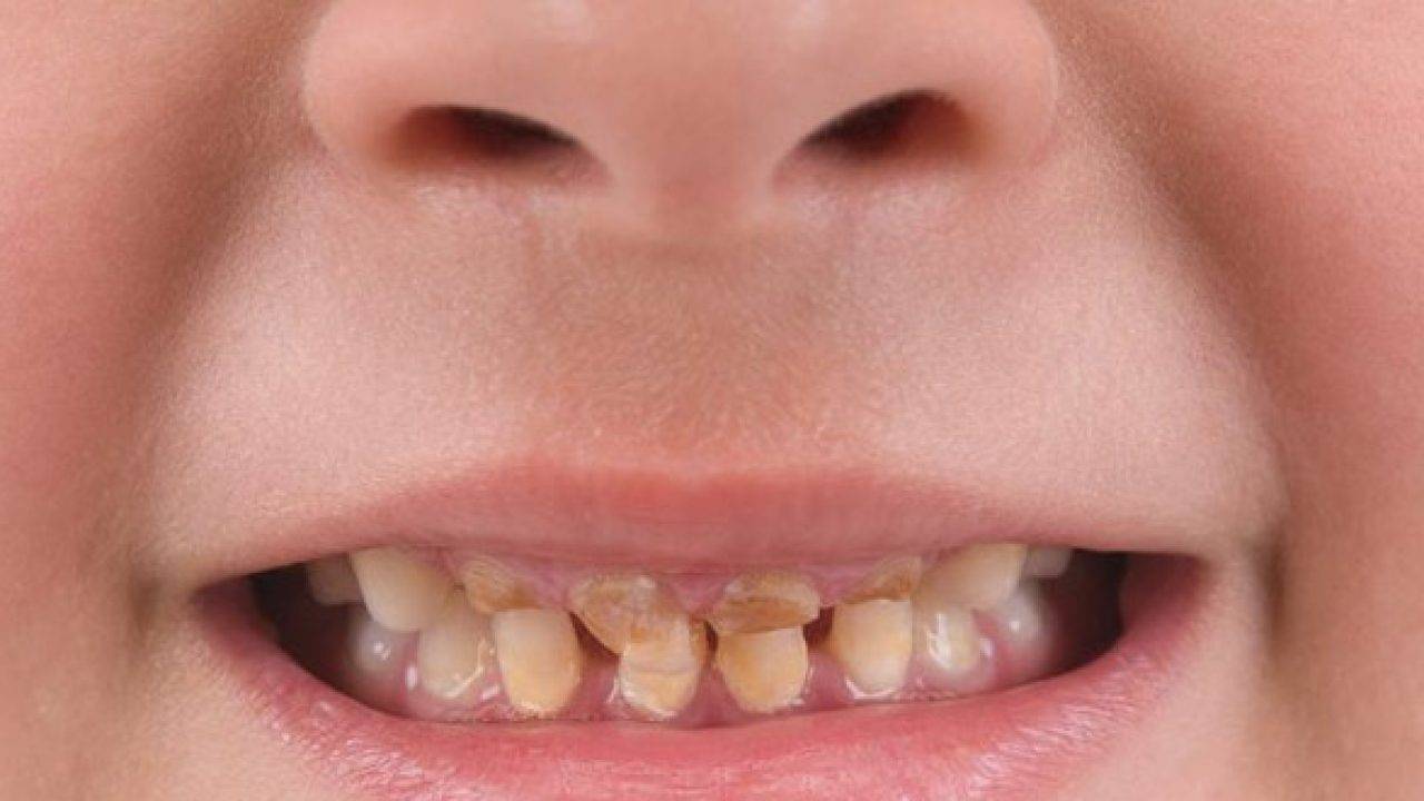 Ребенок без молочных зубов. Гипоплазия эмали молочных зубов.