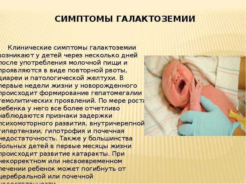 Галактоземия