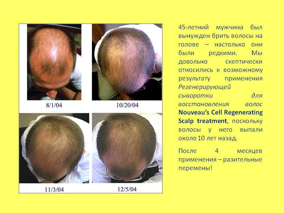 Почему у новорожденного ребенка плохо растут волосы?