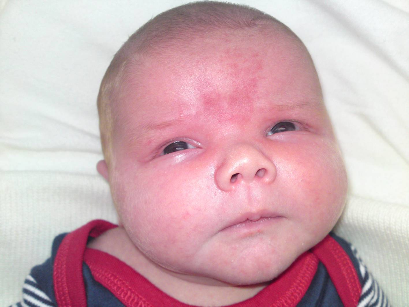 Сыпь у грудничка: фото и описание высыпаний у новорожденного