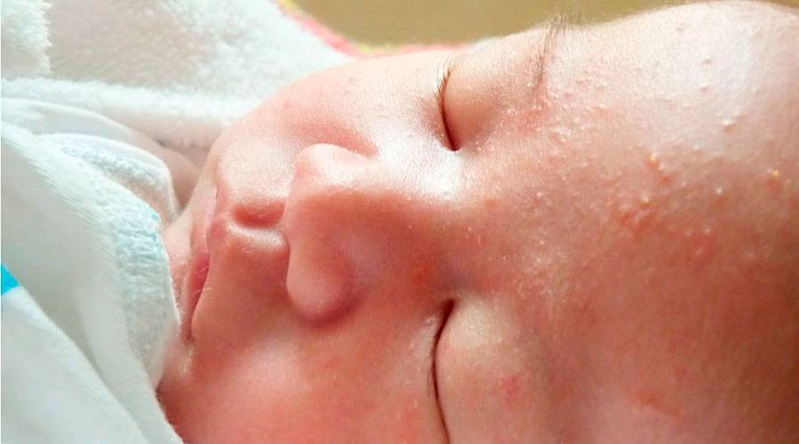 Сыпь у новорожденного: как определить причину