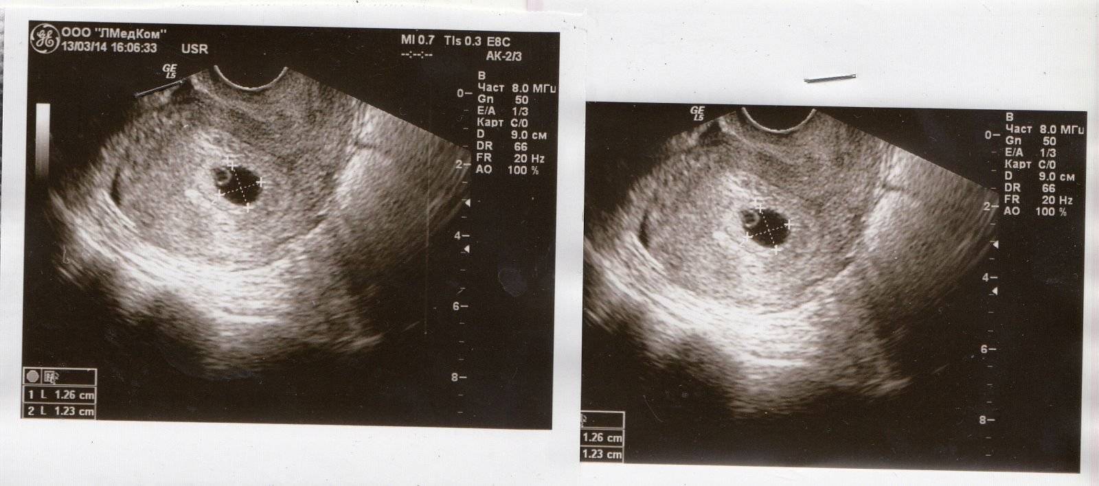 Что происходит на 5 неделе беременности: признаки, ощущения,  фото