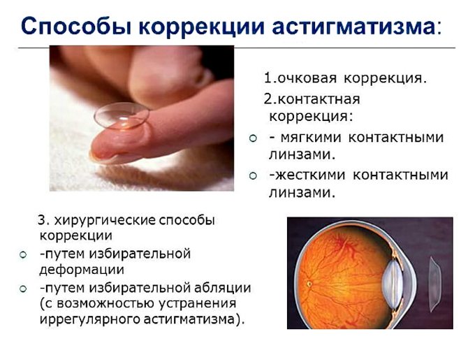 Астигматизм и его виды, особенности лечения астигматизма у детей