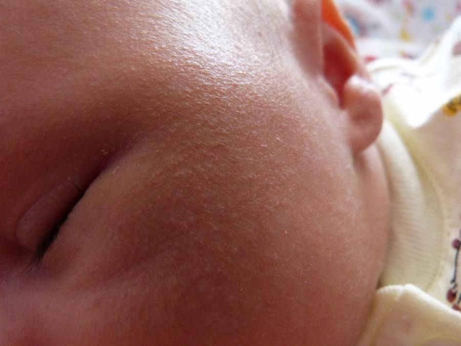Белые прыщики у новорожденных на лице: причины, фото, лечение, профилактика