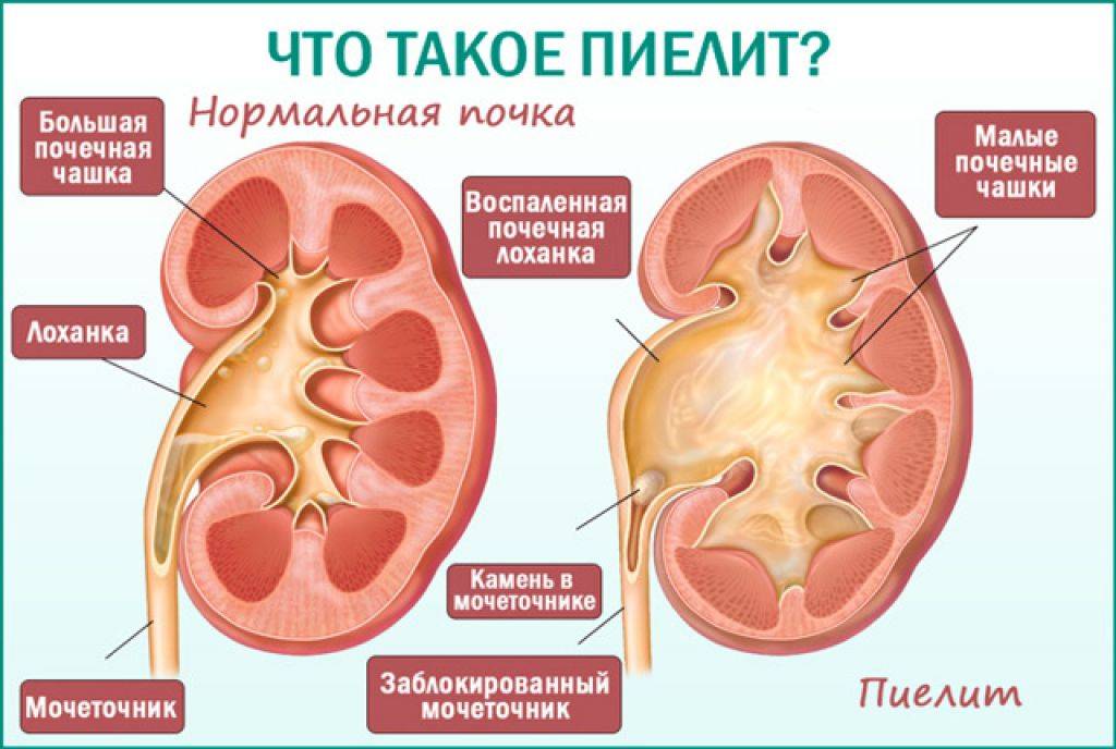 Пиелонефрит у детей картинки