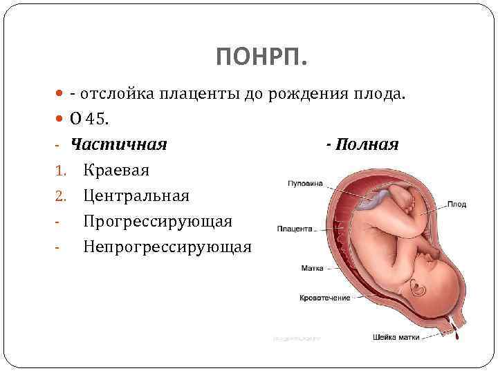 Плацента на рубце матки. Отслойка плаценты у беременных. Полная и частичная отслойка плаценты. Отслойка при беременности 1 триместр. Плацентарная отслойка при беременности.