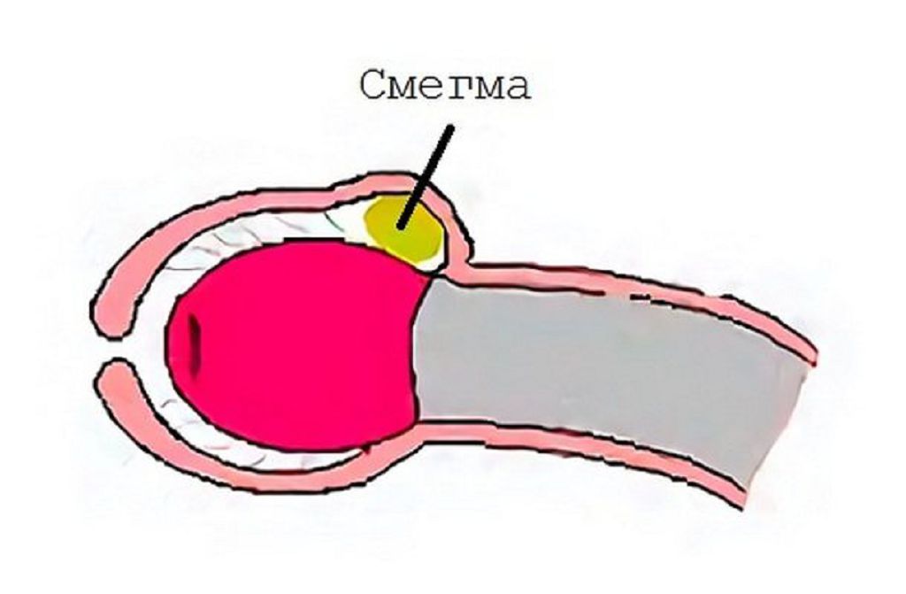 Как правильно раскрыть головку у мальчика: процедура без болевых ощущений
