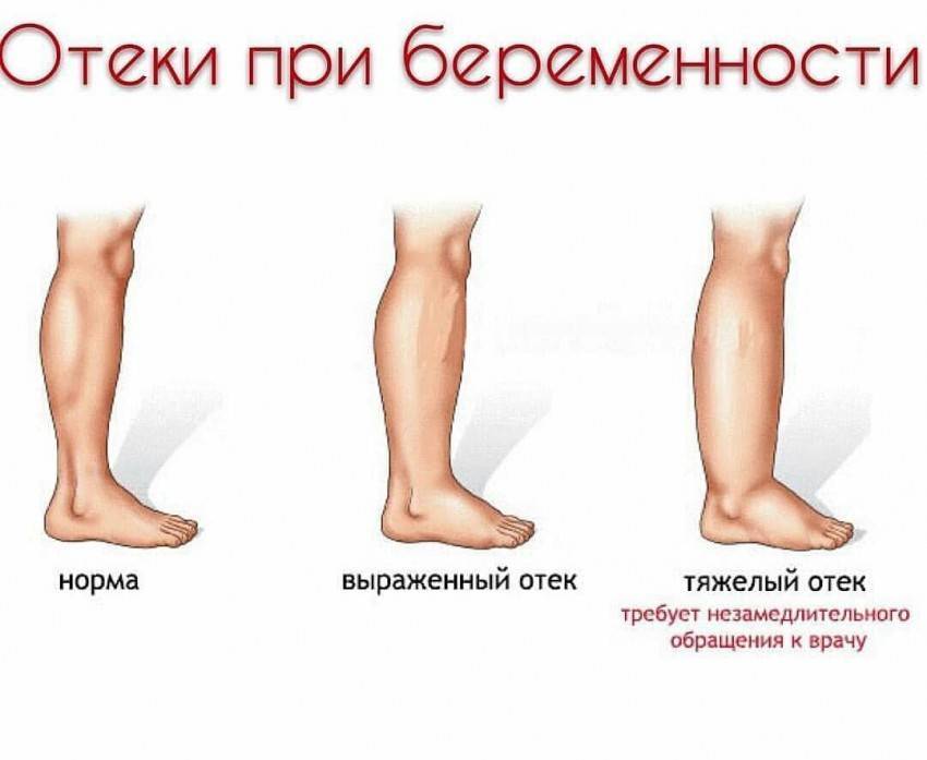 Отеки при беременности на ранних и поздних сроках: что делать и как избавиться в домашних условиях?