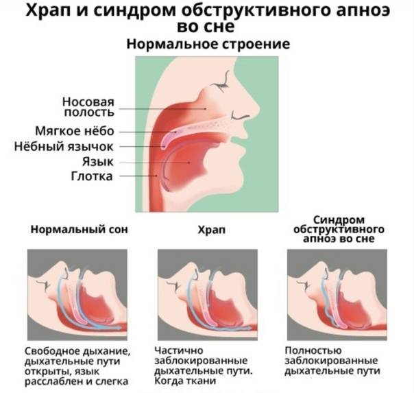 Что делать, если у новорожденного ребенка заложен нос и малыш плохо дышит?