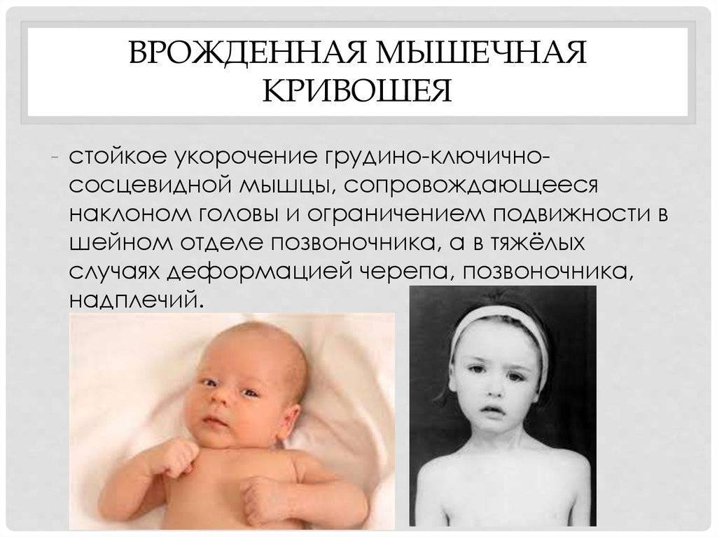 Лечение кривошеи у новорожденных: признаки, как лечить у грудничков в 3 месяца
