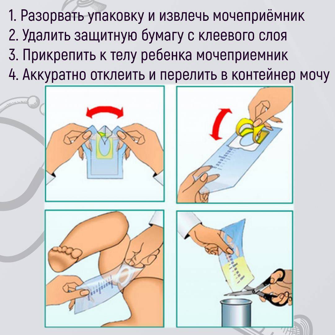 Как собрать мочу у грудничка: девочки и мальчика? чем собрать мочу у новорожденного? применение мочеприемника