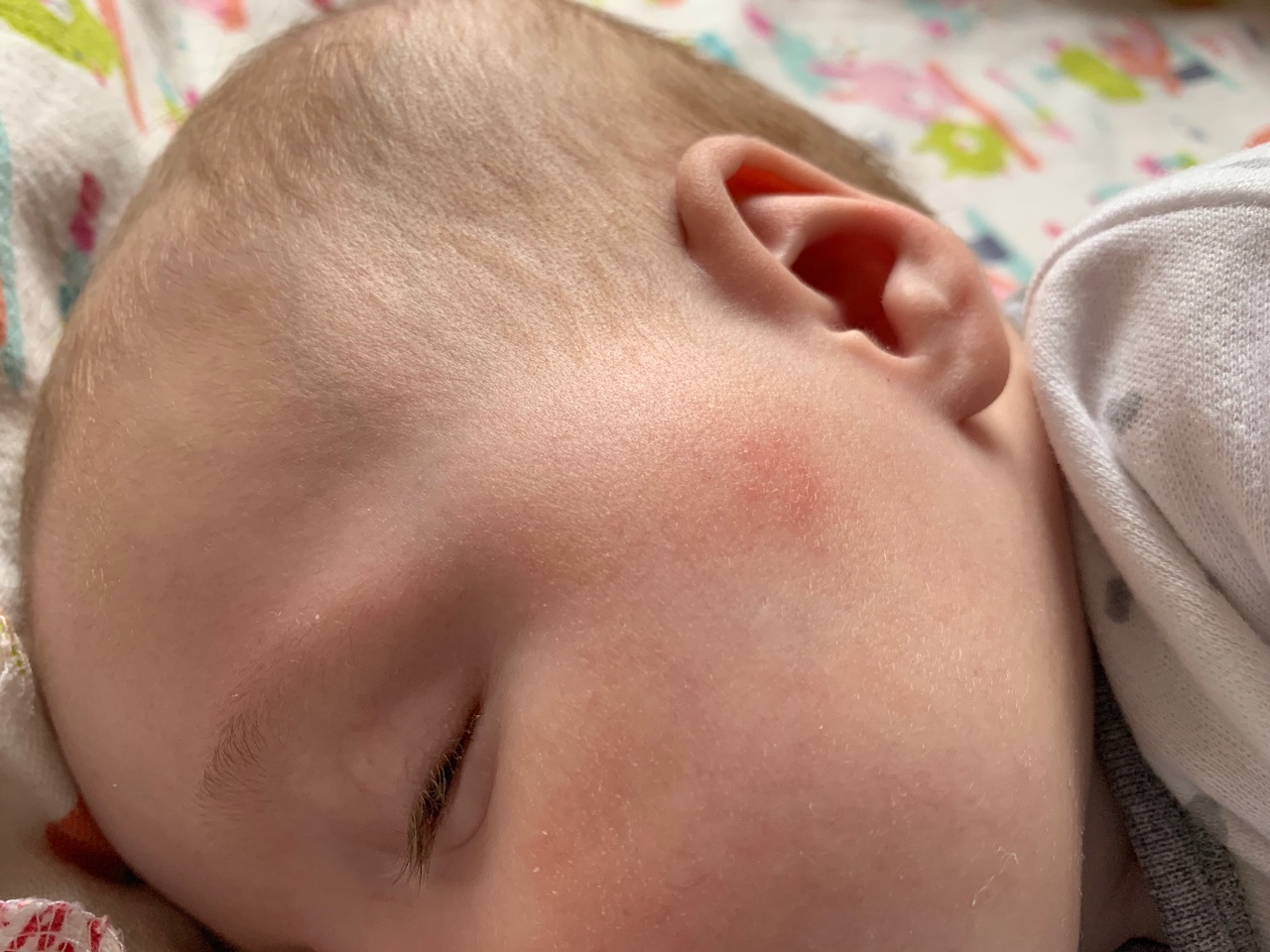 Потница у новорожденных: почему она появляется и как ее лечить