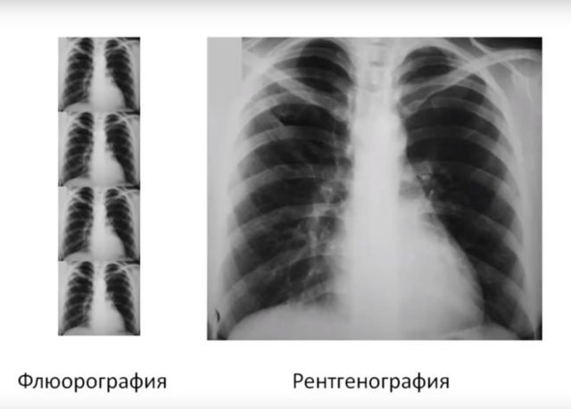Можно ли делать флюорографию при грудном вскармливании | s-voi.ru