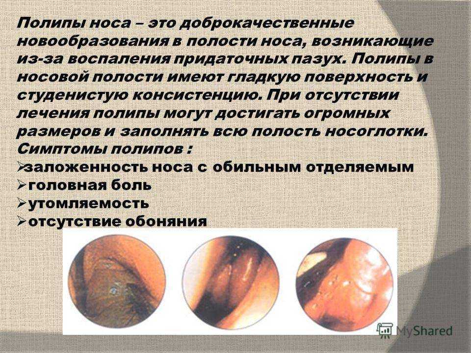 Полипы полости носа и околоносовых пазух (полипоз носа) - как лечить?