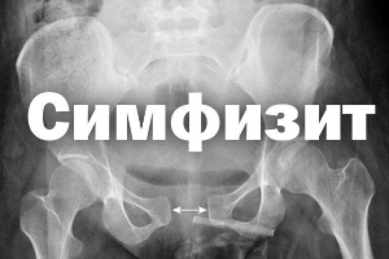 Дисфункция лобкового симфиза