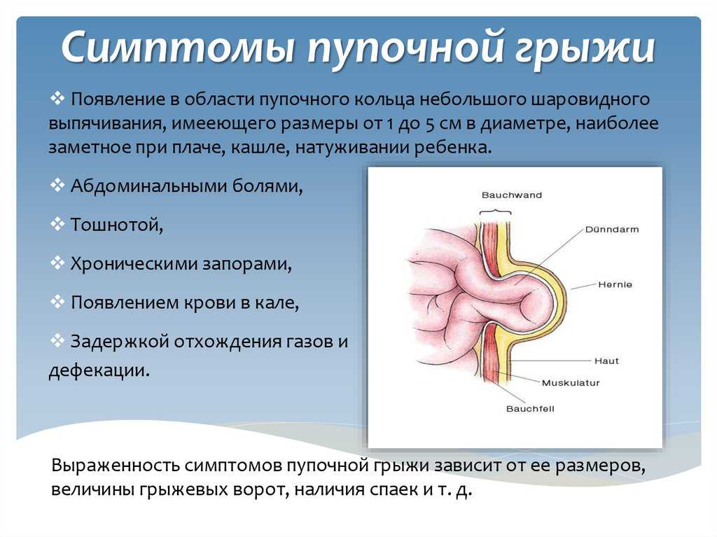Пупочная грыжа у детей: симптомы, лечение