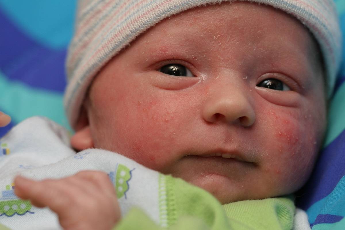 Прыщики на лице у новорожденного: разновидности, белые, красные,чем лечить, что можно делать а что нельзя