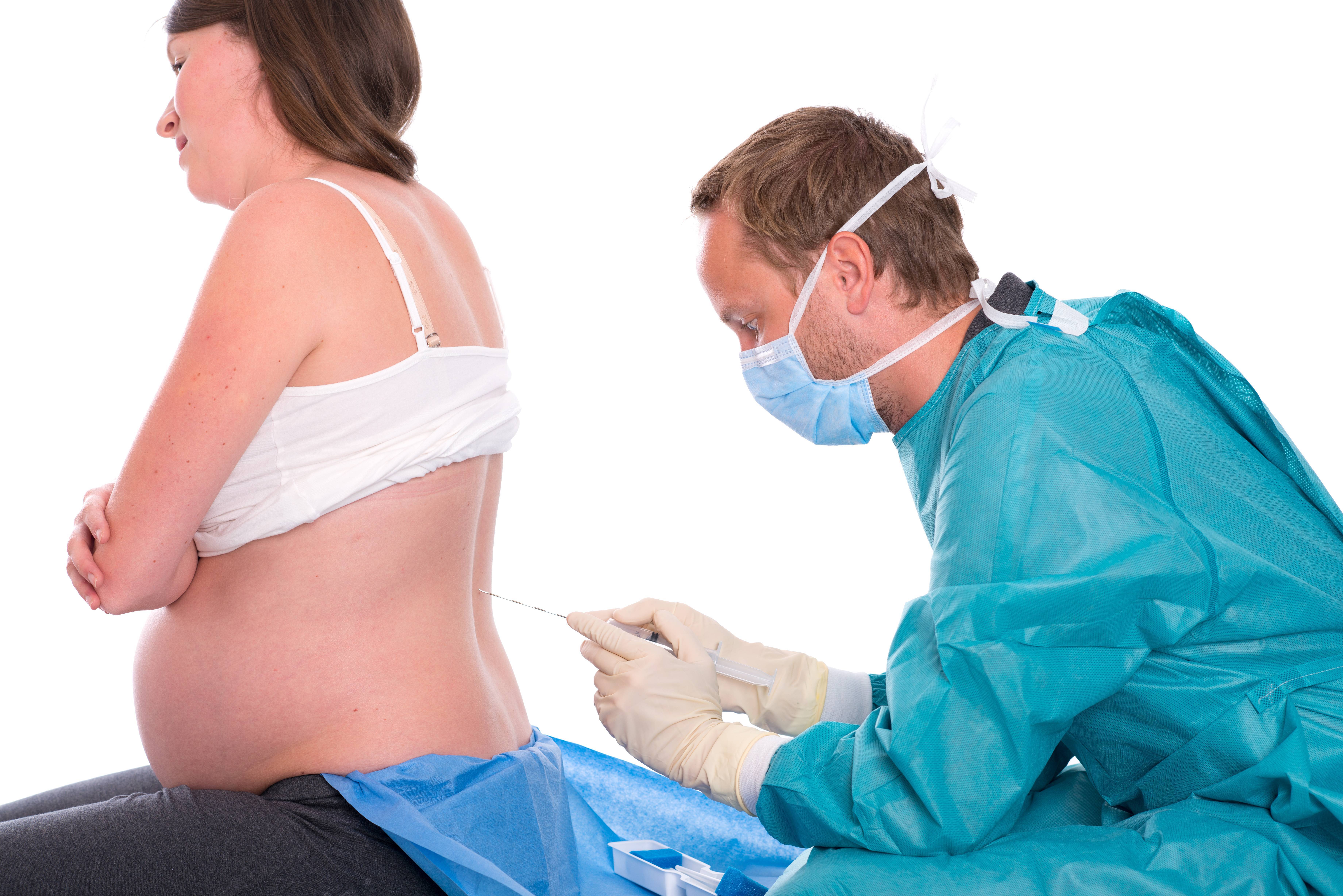 Рождение ребенка в 50. Эпидуральная анестезия. Эпидуральная анесттез. Эпидуральная анестезия беременных.