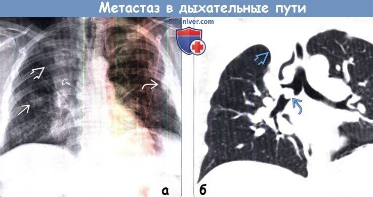 Можно ли делать рентген кормящей маме?