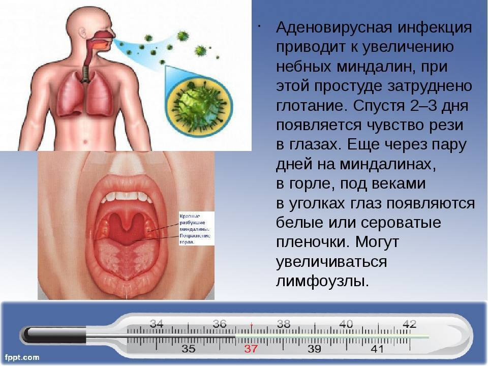 Многоликий аденовирус. про особенности аденовирусной инфекции у детей, об ее лечении и профилактике рассказывает педиатр