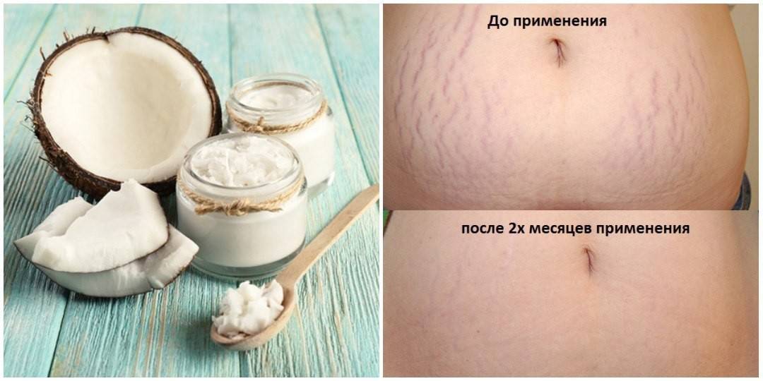 Как избавиться от растяжек