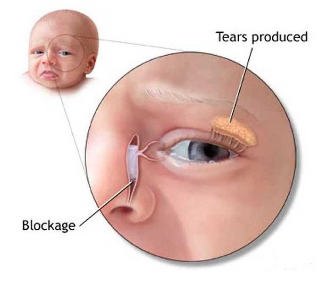 Гноятся глазки у новорожденного – чем лечить глазки, что делать