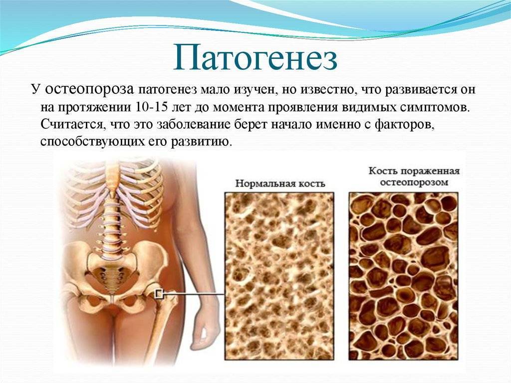 Мраморная болезнь