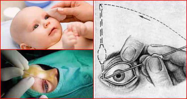 Зондирование слёзного канала у новорождённых: техника проведения