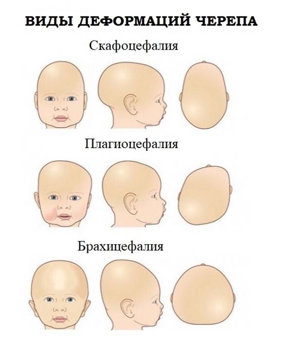 Голова в 4 месяца. Нормальная форма головы у грудничка. Правильная форма головы у грудничка. Форма черепа у новорожденного норма.